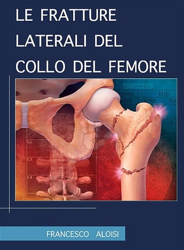 Le fratture laterali del collo del femore - Francesco Aloisi - eBook -  Mondadori Store